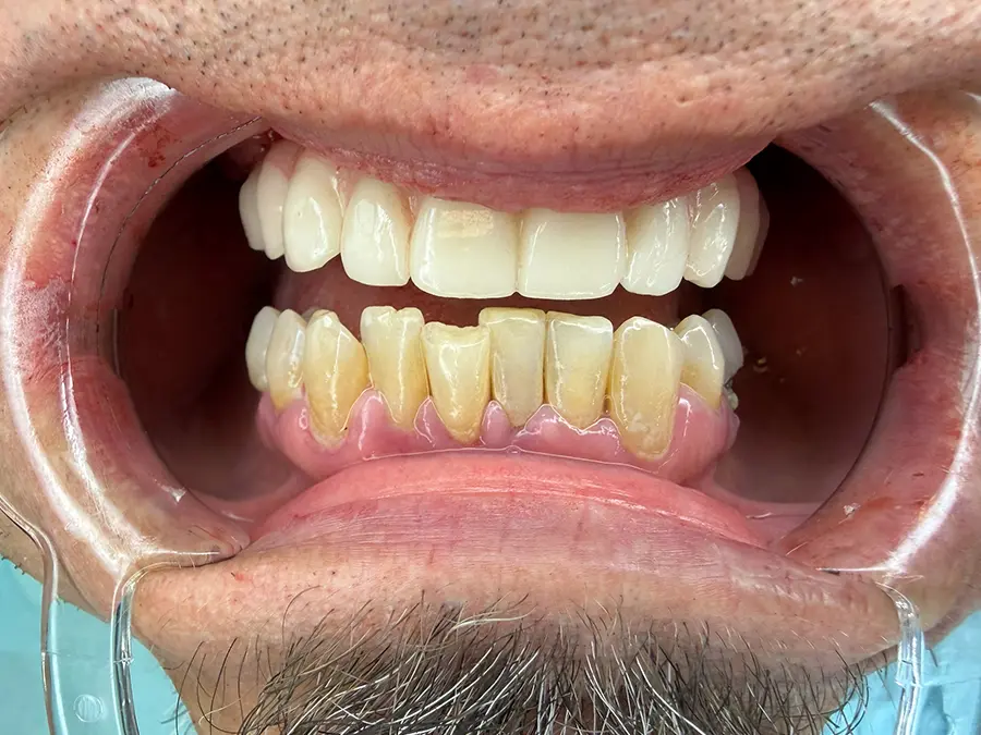 Patient (2) After Dental Implants