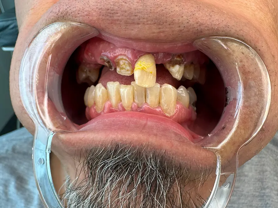Patient (2) Before Dental Implants
